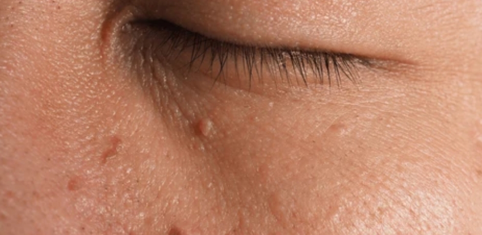 Facial Wart Treatment: I Tried Castor Oil On Warts For 2 Weeks And The Results Are Shocking Facial Wart image near eyes